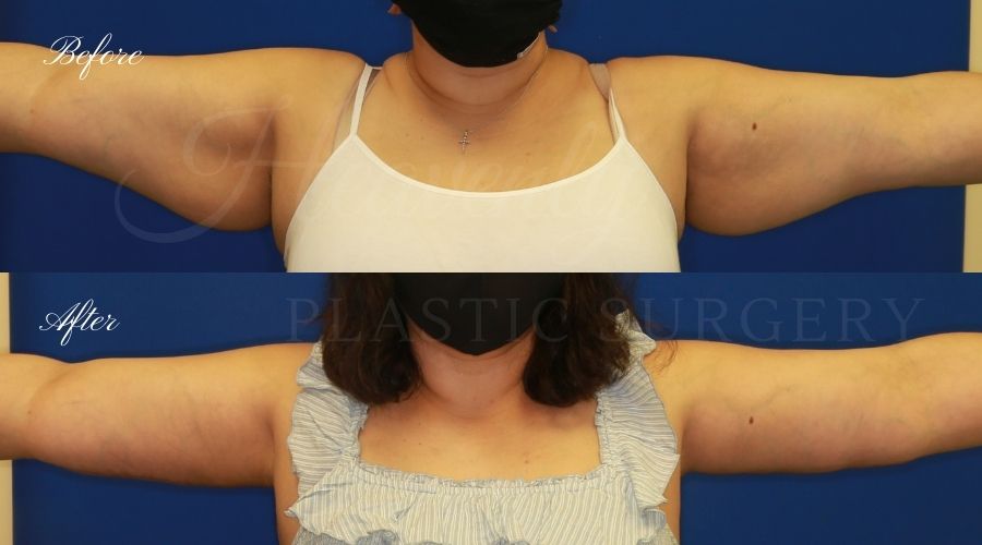 Plastic Surgery, Liposuction, Arm Lift, Brachioplasty, arms, bat wings Plastic Surgery, Liposuction, Arm Lift, Brachioplasty, arms, bat wings