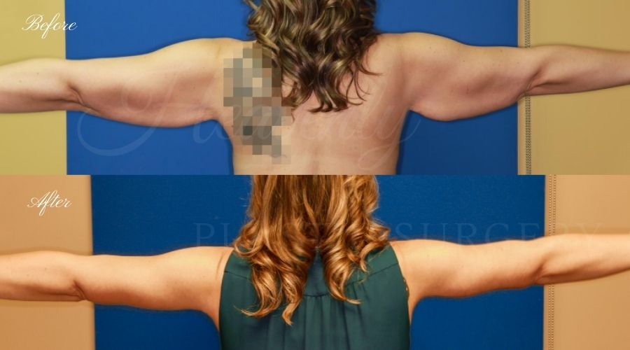 Plastic Surgery, Liposuction, Arm Lift, Brachioplasty, arms, bat wings Plastic Surgery, Liposuction, Arm Lift, Brachioplasty, arms, bat wings