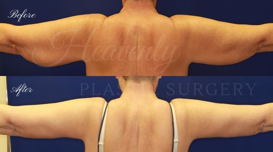 Plastic Surgery, Liposuction, Arm Lift, Brachioplasty, arms, bat wings