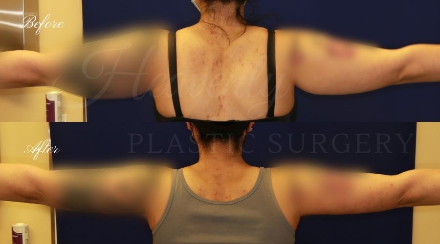 Plastic Surgery, Liposuction, Arm Lift, Brachioplasty, arms, bat wings