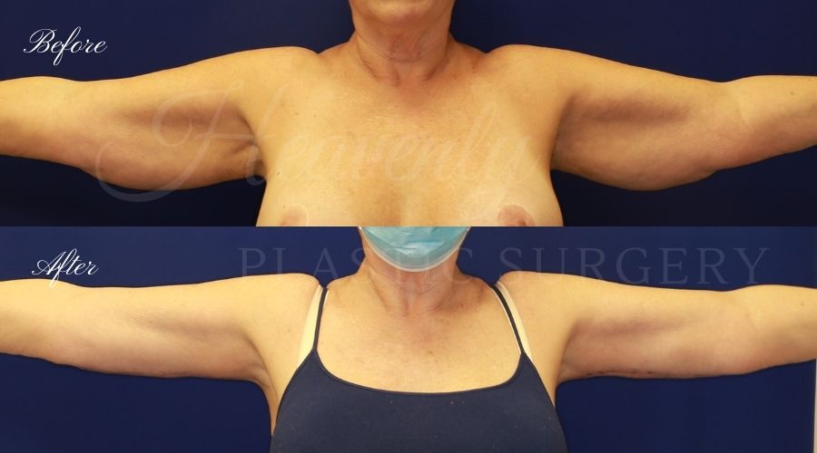 Plastic Surgery, Liposuction, Arm Lift, Brachioplasty, arms, bat wings