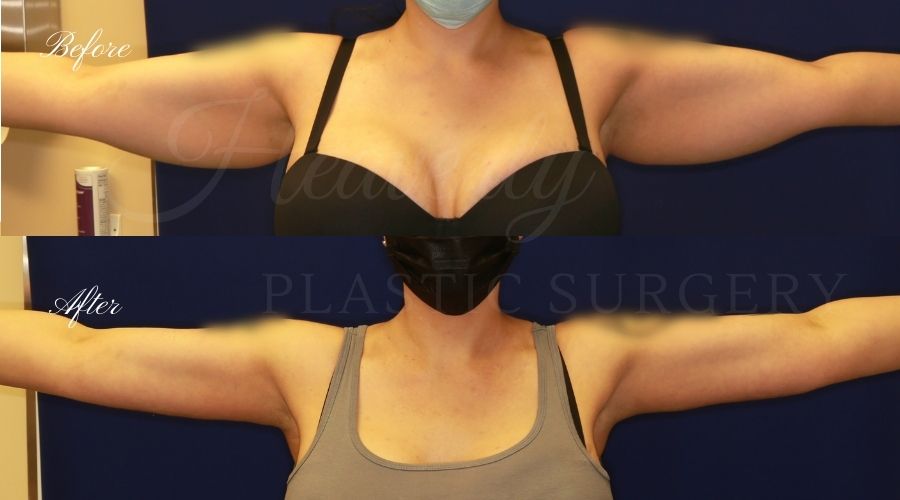 Plastic Surgery, Liposuction, Arm Lift, Brachioplasty, arms, bat wings