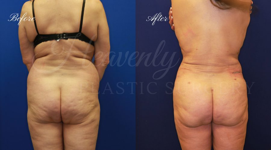 BBL Orange county, brazilian butt lift orange county, brazilian butt lift before and after, brazilian butt lift surgeon, brazilian butt lift results, bbl surgeon, bbl results, bbl before and after, fat transfer to the butt, butt augmentation, butt augmentation surgery, butt augmentation surgeon BBL Orange county, brazilian butt lift orange county, brazilian butt lift before and after, brazilian butt lift surgeon, brazilian butt lift results, bbl surgeon, bbl results, bbl before and after, fat transfer to the butt, butt augmentation, butt augmentation surgery, butt augmentation surgeon