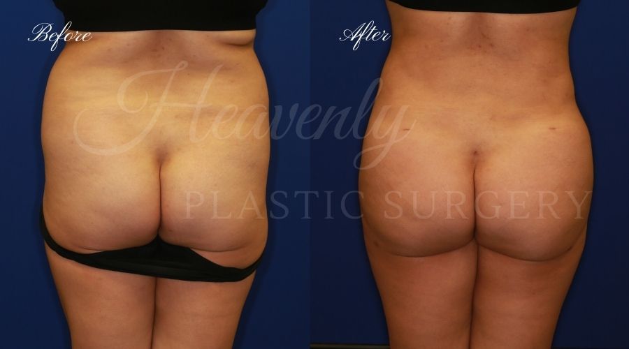 Heavenly Plastic Surgery, Plastic Surgery, Plastic Surgeon, Liposuction, Abdominal Liposuction, Lipo 360, Liposuction 360, BBL, Brazilian Butt Lift, Fat Transfer