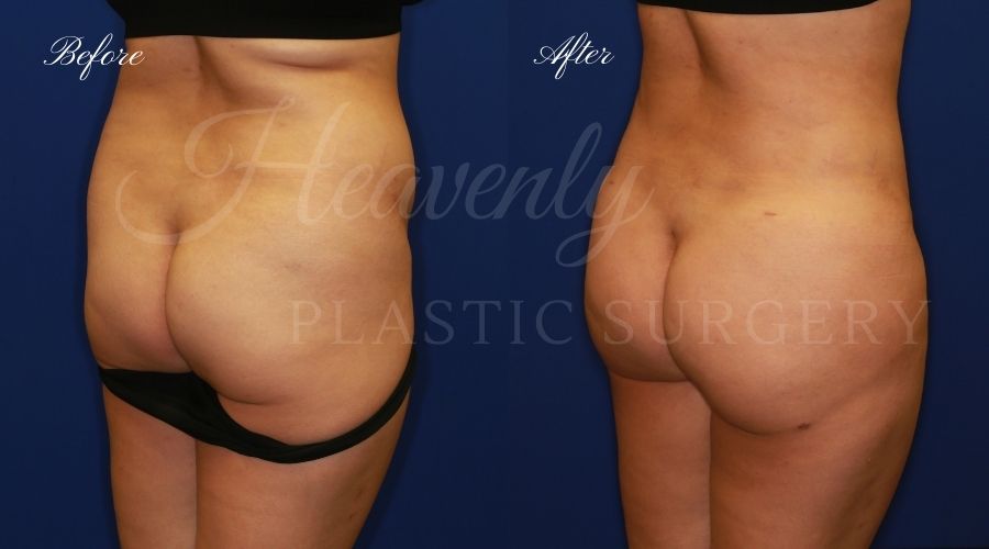 Heavenly Plastic Surgery, Plastic Surgery, Plastic Surgeon, Liposuction, Abdominal Liposuction, Lipo 360, Liposuction 360, BBL, Brazilian Butt Lift, Fat Transfer