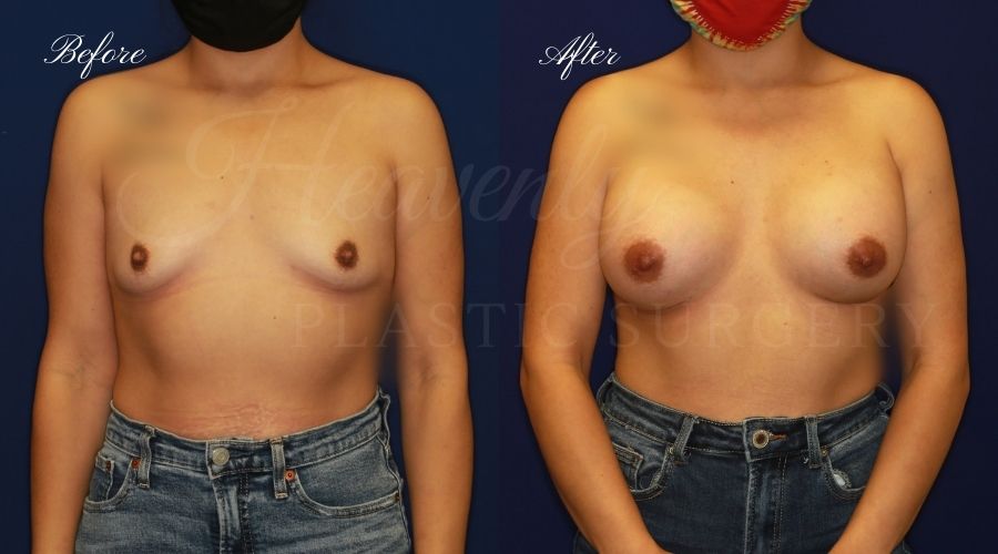 breast augmentation before and after, breast augmentation results, breast augmentation surgery, breast implants before and after, breast implants results, plastic surgery before and after, plastic surgery results, plastic surgeon, breast surgeon, breast augmentation surgeon, breast implant surgeon, breast implants orange county, breast augmentation orange county, orange county plastic surgeon, plastic surgery check