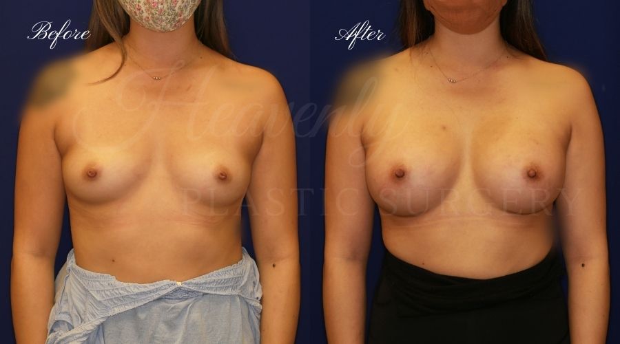 breast augmentation before and after, breast augmentation results, breast augmentation surgery, breast implants before and after, breast implants results, plastic surgery before and after, plastic surgery results, plastic surgeon, breast surgeon, breast augmentation surgeon, breast implant surgeon, breast implants orange county, breast augmentation orange county, orange county plastic surgeon, plastic surgery check