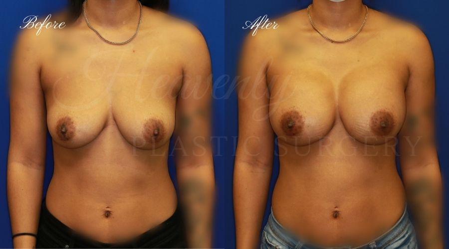 breast augmentation before and after, breast augmentation results, breast augmentation surgery, breast implants before and after, breast implants results, plastic surgery before and after, plastic surgery results, plastic surgeon, breast surgeon, breast augmentation surgeon, breast implant surgeon, breast implants orange county, breast augmentation orange county, orange county plastic surgeon, plastic surgery check