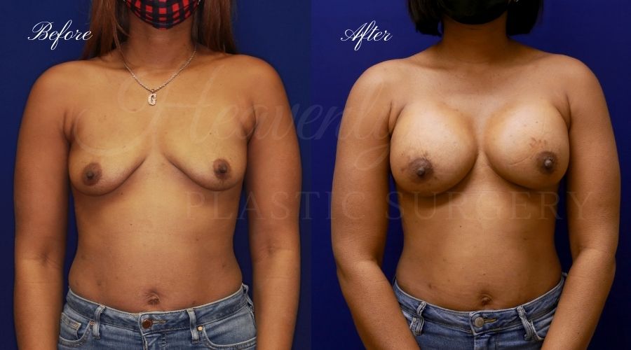 breast augmentation before and after, breast augmentation results, breast augmentation surgery, breast implants before and after, breast implants results, plastic surgery before and after, plastic surgery results, plastic surgeon, breast surgeon, breast augmentation surgeon, breast implant surgeon, breast implants orange county, breast augmentation orange county, orange county plastic surgeon, plastic surgery check