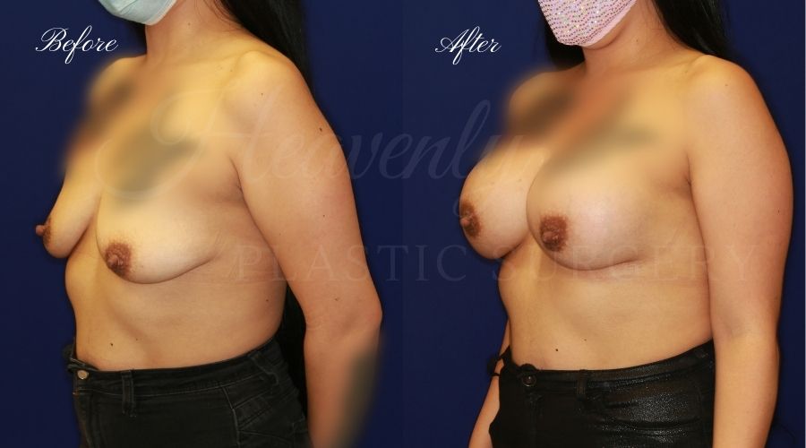 breast augmentation before and after, breast augmentation results, breast augmentation surgery, breast implants before and after, breast implants results, plastic surgery before and after, plastic surgery results, plastic surgeon, breast surgeon, breast augmentation surgeon, breast implant surgeon, breast implants orange county, breast augmentation orange county, orange county plastic surgeon, plastic surgery check