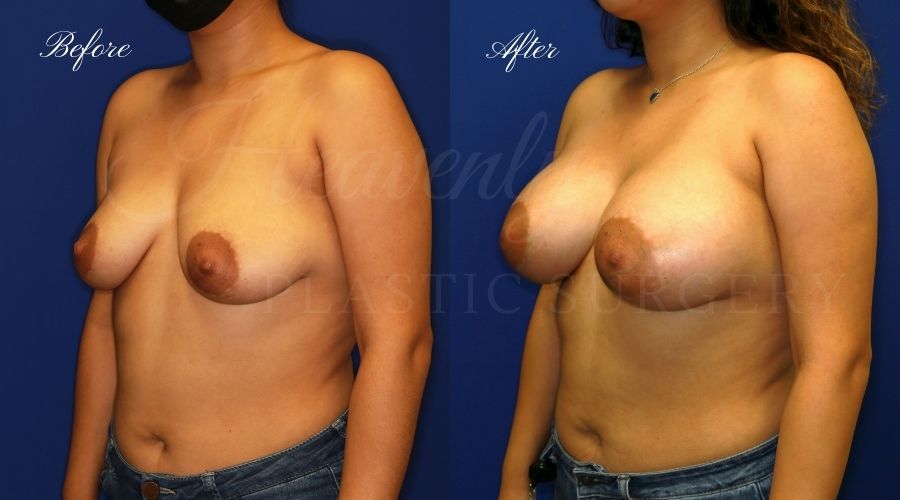 breast augmentation before and after, breast augmentation results, breast augmentation surgery, breast implants before and after, breast implants results, plastic surgery before and after, plastic surgery results, plastic surgeon, breast surgeon, breast augmentation surgeon, breast implant surgeon, breast implants orange county, breast augmentation orange county, orange county plastic surgeon, plastic surgery check