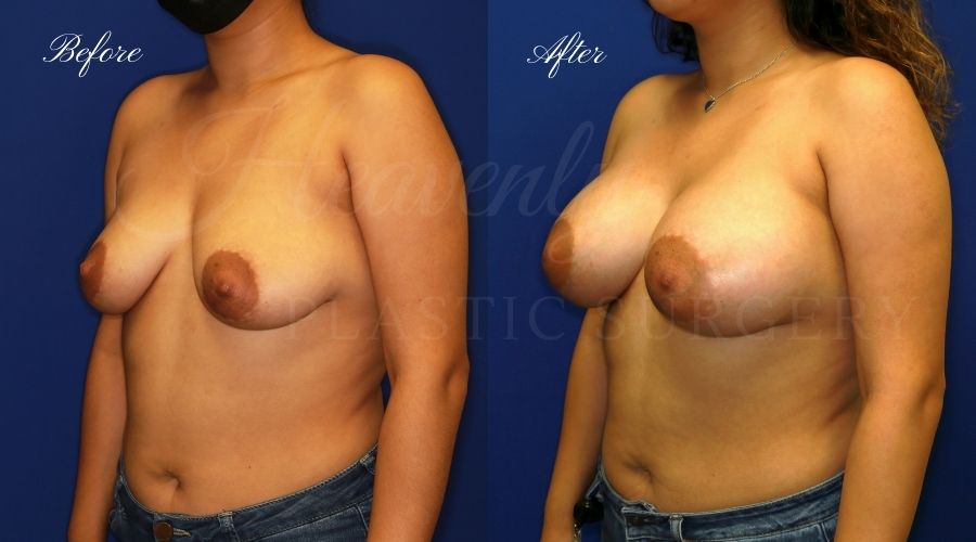 breast augmentation before and after, breast augmentation results, breast augmentation surgery, breast implants before and after, breast implants results, plastic surgery before and after, plastic surgery results, plastic surgeon, breast surgeon, breast augmentation surgeon, breast implant surgeon, breast implants orange county, breast augmentation orange county, orange county plastic surgeon, plastic surgery check breast augmentation before and after, breast augmentation results, breast augmentation surgery, breast implants before and after, breast implants results, plastic surgery before and after, plastic surgery results, plastic surgeon, breast surgeon, breast augmentation surgeon, breast implant surgeon, breast implants orange county, breast augmentation orange county, orange county plastic surgeon, plastic surgery check