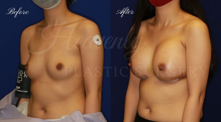 breast augmentation before and after, breast augmentation results, breast augmentation surgery, breast implants before and after, breast implants results, plastic surgery before and after, plastic surgery results, plastic surgeon, breast surgeon, breast augmentation surgeon, breast implant surgeon, breast implants orange county, breast augmentation orange county, orange county plastic surgeon, plastic surgery check