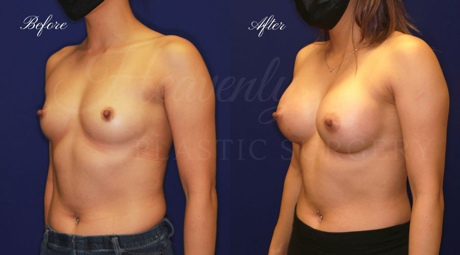 breast augmentation before and after, breast augmentation results, breast augmentation surgery, breast implants before and after, breast implants results, plastic surgery before and after, plastic surgery results, plastic surgeon, breast surgeon, breast augmentation surgeon, breast implant surgeon, breast implants orange county, breast augmentation orange county, orange county plastic surgeon, plastic surgery check