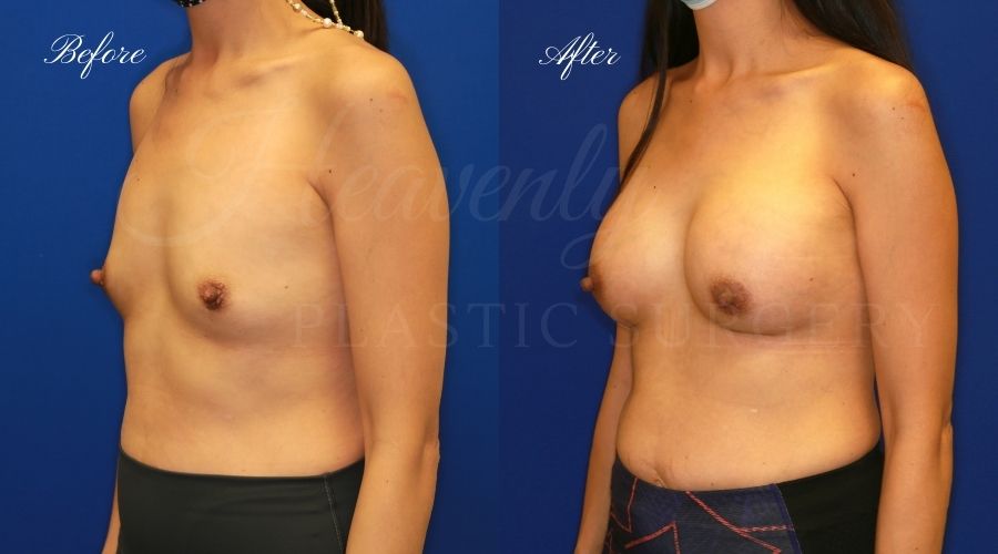 breast augmentation before and after, breast augmentation results, breast augmentation surgery, breast implants before and after, breast implants results, plastic surgery before and after, plastic surgery results, plastic surgeon, breast surgeon, breast augmentation surgeon, breast implant surgeon, breast implants orange county, breast augmentation orange county, orange county plastic surgeon, plastic surgery check