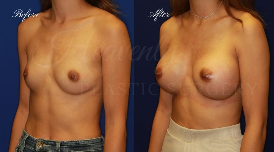 breast augmentation before and after, breast augmentation results, breast augmentation surgery, breast implants before and after, breast implants results, plastic surgery before and after, plastic surgery results, plastic surgeon, breast surgeon, breast augmentation surgeon, breast implant surgeon, breast implants orange county, breast augmentation orange county, orange county plastic surgeon, plastic surgery check