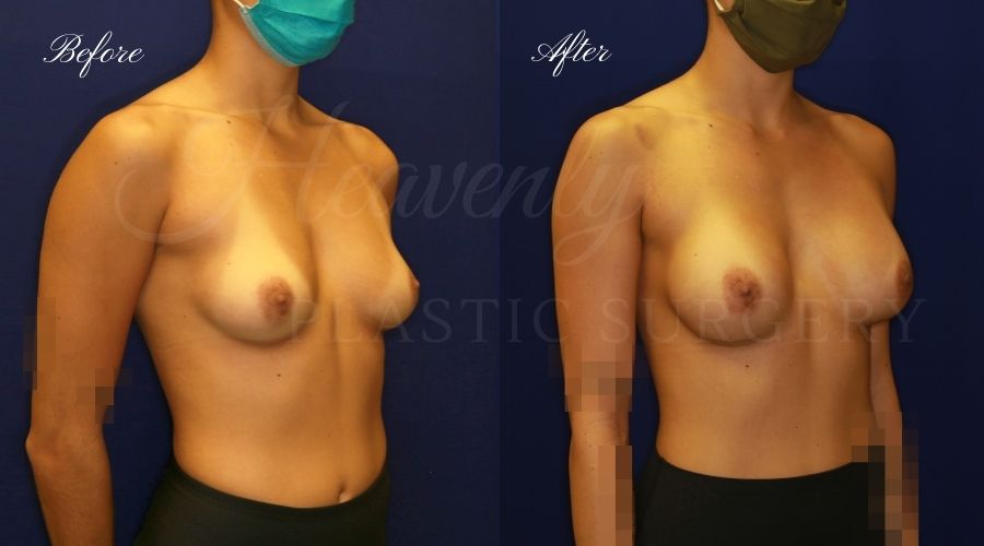 breast augmentation before and after, breast augmentation results, breast augmentation surgery, breast implants before and after, breast implants results, plastic surgery before and after, plastic surgery results, plastic surgeon, breast surgeon, breast augmentation surgeon, breast implant surgeon, breast implants orange county, breast augmentation orange county, orange county plastic surgeon, plastic surgery check