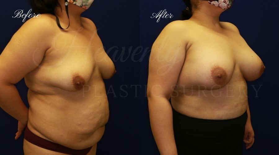 breast augmentation before and after, breast augmentation results, breast augmentation surgery, breast implants before and after, breast implants results, plastic surgery before and after, plastic surgery results, plastic surgeon, breast surgeon, breast augmentation surgeon, breast implant surgeon, breast implants orange county, breast augmentation orange county, orange county plastic surgeon, plastic surgery check breast augmentation before and after, breast augmentation results, breast augmentation surgery, breast implants before and after, breast implants results, plastic surgery before and after, plastic surgery results, plastic surgeon, breast surgeon, breast augmentation surgeon, breast implant surgeon, breast implants orange county, breast augmentation orange county, orange county plastic surgeon, plastic surgery check