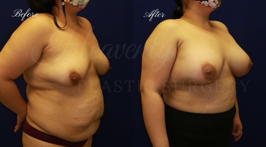 breast augmentation before and after, breast augmentation results, breast augmentation surgery, breast implants before and after, breast implants results, plastic surgery before and after, plastic surgery results, plastic surgeon, breast surgeon, breast augmentation surgeon, breast implant surgeon, breast implants orange county, breast augmentation orange county, orange county plastic surgeon, plastic surgery check