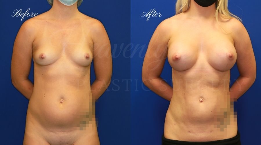 breast augmentation before and after, breast augmentation results, breast augmentation surgery, breast implants before and after, breast implants results, plastic surgery before and after, plastic surgery results, plastic surgeon, breast surgeon, breast augmentation surgeon, breast implant surgeon, breast implants orange county, breast augmentation orange county, orange county plastic surgeon, plastic surgery check, liposuction results, liposuction before and after, lipoetchin g before and after, liposuction orange county, liposuction surgeon, liposuction 360, liposuction 360 orange county, liposuction 360 surgeon breast augmentation before and after, breast augmentation results, breast augmentation surgery, breast implants before and after, breast implants results, plastic surgery before and after, plastic surgery results, plastic surgeon, breast surgeon, breast augmentation surgeon, breast implant surgeon, breast implants orange county, breast augmentation orange county, orange county plastic surgeon, plastic surgery check, liposuction results, liposuction before and after, lipoetchin g before and after, liposuction orange county, liposuction surgeon, liposuction 360, liposuction 360 orange county, liposuction 360 surgeon