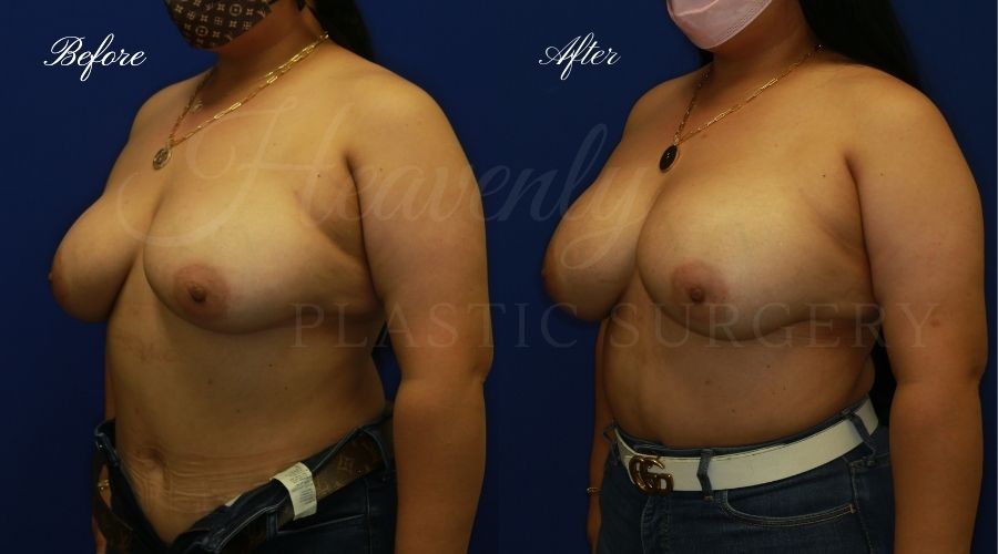 Plastic surgery, plastic surgeon, breast surgery, breast implant revision, deflated breast implant, breast augmentation correction