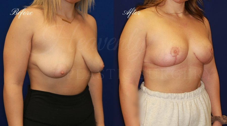 Breast lift surgery, breast lift, breast lift surgeon, mastopexy, mastopexy surgery, breast lift without implants, breast lift orange county, plastic surgery before and after, breast lift before and after, breast lift results, breast reduction, breast reduction results, plastic surgeon, plastic surgery, orange county plastic surgery, orange county plastic surgeon Breast lift surgery, breast lift, breast lift surgeon, mastopexy, mastopexy surgery, breast lift without implants, breast lift orange county, plastic surgery before and after, breast lift before and after, breast lift results, breast reduction, breast reduction results, plastic surgeon, plastic surgery, orange county plastic surgery, orange county plastic surgeon