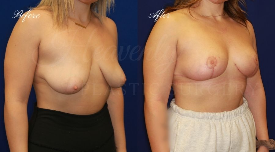 Breast lift surgery, breast lift, breast lift surgeon, mastopexy, mastopexy surgery, breast lift without implants, breast lift orange county, plastic surgery before and after, breast lift before and after, breast lift results, breast reduction, breast reduction results, plastic surgeon, plastic surgery, orange county plastic surgery, orange county plastic surgeon