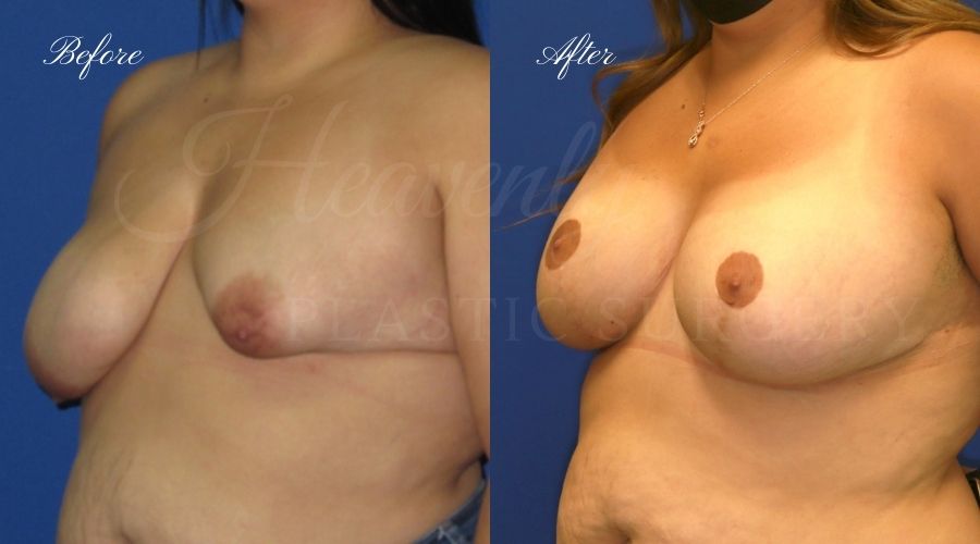 Mastopexy Augmentatio, Breast Implants with Lift, Silicone breast implants with Wise-pattern breast lift (Anchor scar), plastic surgery, plastic surgeon, orange county, lake forest, sagging