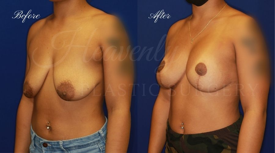 Breast Lift with Implants (Mastopexy-Augmentation) Before and After, Plastic surgery, plastic surgeon, breast augmentation, breast lift, breast implants, mastopexy, mastoaug, mastopexy-augmentation, before and after, mastopexy augmentation, breast lift with implants