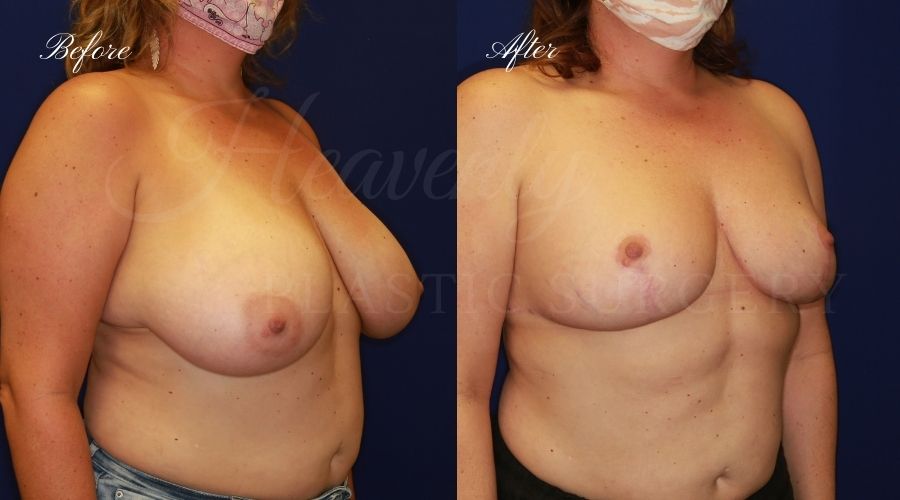 Breast lift surgery, breast lift, breast lift surgeon, mastopexy, mastopexy surgery, breast lift without implants, breast lift orange county, plastic surgery before and after, breast lift before and after, breast lift results, breast reduction, breast reduction results, plastic surgeon, plastic surgery, orange county plastic surgery, orange county plastic surgeon