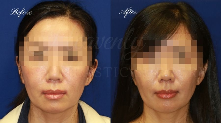 Buccal Fat Pad Removal, Buccal Fat Pad Removal Surgery, Cheekbone surgery, Cheek Plastic Surgery, Cheekbone Plastic Surgery, Cheek Surgery, Cheek Plastic Surgery, Contour