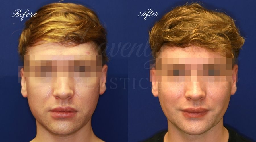 Buccal Fat Pad Removal Before and After Gallery - Heavenly Plastic Surgery