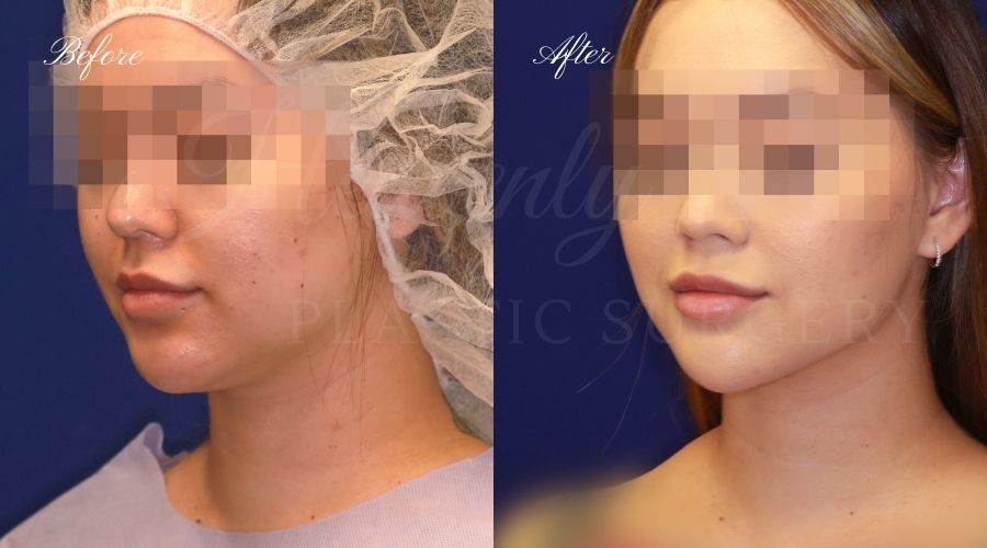 Chin liposuction, liposuction before and after, chin liposuction before and after, chin lipo, jawline surgery, jawline procedure, jawline before and after, chin before and after, plastic surgery before and after, chin liposuction surgeon, liposuction surgeon, plastic surgeon, face surgeon, plastic surgery orange county, chin liposuction orange county, chin lipo orange county, liposuction orange county, medspa orange county, plastic surgery orange county, best plastic surgeon orange county, lake forest plastic surgery, face plastic surgery, face before and after, plastic surgery check