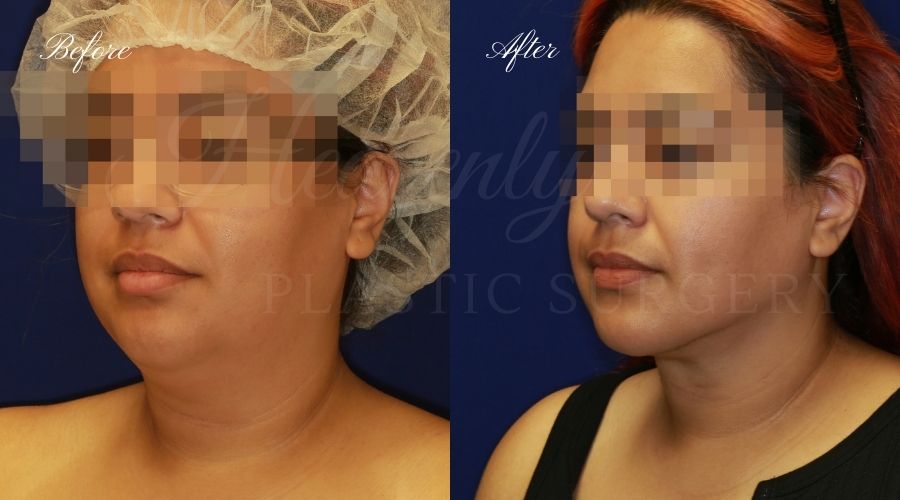 Chin liposuction, liposuction before and after, chin liposuction before and after, chin lipo, jawline surgery, jawline procedure, jawline before and after, chin before and after, plastic surgery before and after, chin liposuction surgeon, liposuction surgeon, plastic surgeon, face surgeon, plastic surgery orange county, chin liposuction orange county, chin lipo orange county, liposuction orange county, medspa orange county, plastic surgery orange county, best plastic surgeon orange county, lake forest plastic surgery, face plastic surgery, face before and after, plastic surgery check