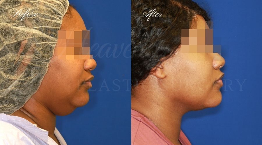 Chin liposuction, liposuction before and after, chin liposuction before and after, chin lipo, jawline surgery, jawline procedure, jawline before and after, chin before and after, plastic surgery before and after, chin liposuction surgeon, liposuction surgeon, plastic surgeon, face surgeon, plastic surgery orange county, chin liposuction orange county, chin lipo orange county, liposuction orange county, medspa orange county, plastic surgery orange county, best plastic surgeon orange county, lake forest plastic surgery, face plastic surgery, face before and after, plastic surgery check