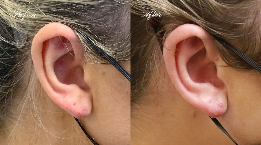 Earlobe Repair Surgery in Orlando | Florida Vein Care