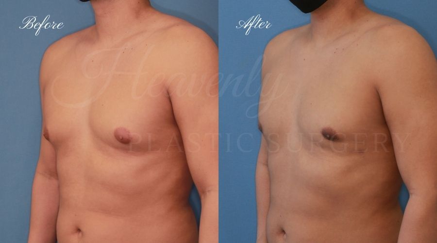 gynecomastia before and after, gynecomastia treatment, gynecomastia results, gynecomastia excision, gynecomastia surgeon, gynecomastia orange county, moobs, man boobs, man boob surgery, male breast tissue, male breast tissue surgery, plastic surgery before and after, plastic surgeon, orange county plastic surgeon, orange county plastic surgery