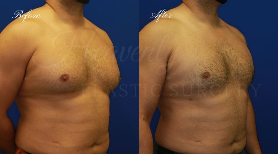 gynecomastia before and after, gynecomastia treatment, gynecomastia results, gynecomastia excision, gynecomastia surgeon, gynecomastia orange county, moobs, man boobs, man boob surgery, male breast tissue, male breast tissue surgery, plastic surgery before and after, plastic surgeon, orange county plastic surgeon, orange county plastic surgery gynecomastia before and after, gynecomastia treatment, gynecomastia results, gynecomastia excision, gynecomastia surgeon, gynecomastia orange county, moobs, man boobs, man boob surgery, male breast tissue, male breast tissue surgery, plastic surgery before and after, plastic surgeon, orange county plastic surgeon, orange county plastic surgery