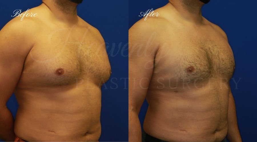 gynecomastia before and after, gynecomastia treatment, gynecomastia results, gynecomastia excision, gynecomastia surgeon, gynecomastia orange county, moobs, man boobs, man boob surgery, male breast tissue, male breast tissue surgery, plastic surgery before and after, plastic surgeon, orange county plastic surgeon, orange county plastic surgery