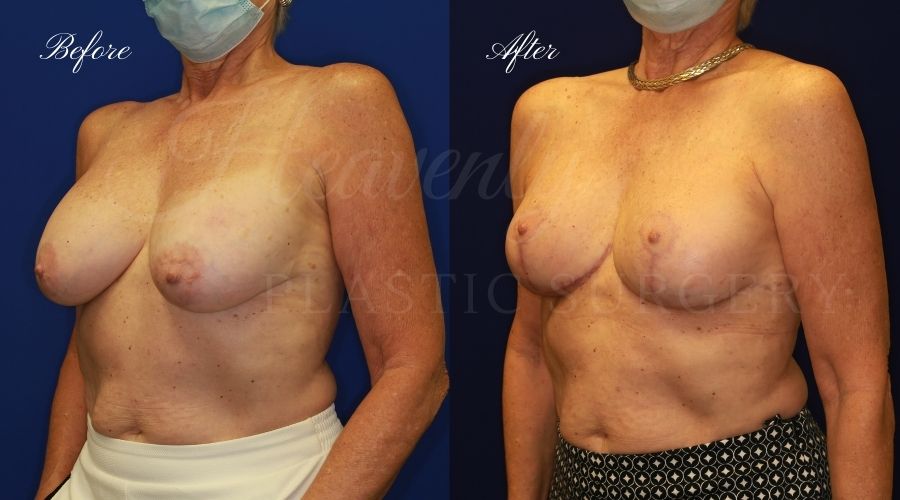 Breast Lift with Implants (Mastopexy-Augmentation) Before and After, Plastic surgery, plastic surgeon, breast augmentation, breast lift, breast implants, mastopexy, mastoaug, mastopexy-augmentation, before and after, mastopexy augmentation, breast lift with implants