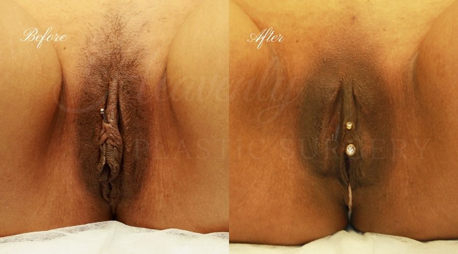 Labiaplasty Before and After - Labia Minora and Labia Majora - TRQU Labiaplasty, vaginal surgery, vaginal rejuvenation, vaginal reconstruction, vaginal rejuvination, labiaplasty orange county, labiaplasty surgery, labia minora, labia majora