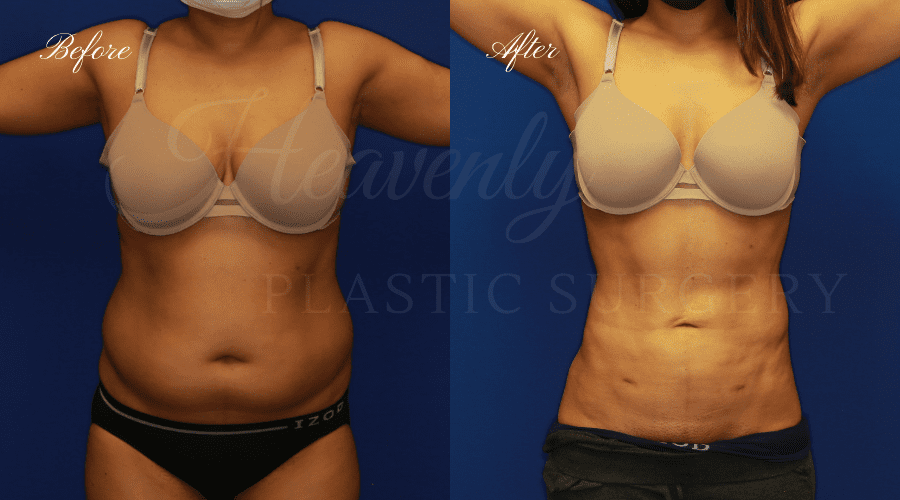 Liposuction 360, liposuction, lipo 360, liposuction surgeon, liposuction orange county, lipo 360 orange county, lipoetching orange county, back liposuction, stomach liposuction, liposuction before and after, lipoetching before and after, liposuction 360 before and after, liposuction results, lipoetching results