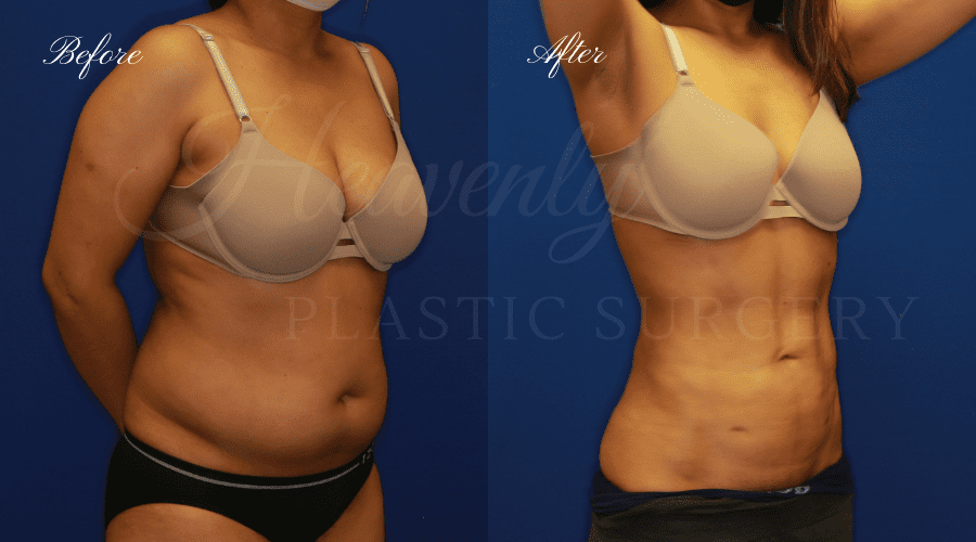 Liposuction 360, liposuction, lipo 360, liposuction surgeon, liposuction orange county, lipo 360 orange county, lipoetching orange county, back liposuction, stomach liposuction, liposuction before and after, lipoetching before and after, liposuction 360 before and after, liposuction results, lipoetching results