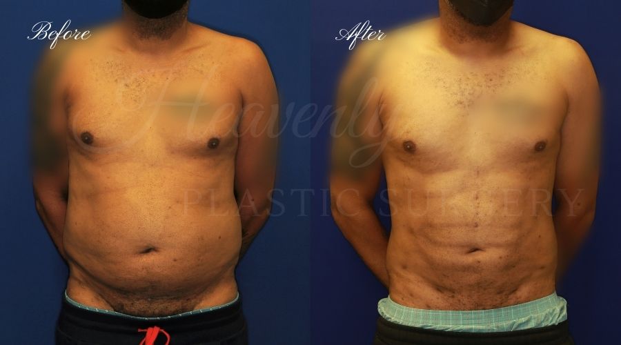 Liposuction 360, liposuction, lipo 360, liposuction surgeon, liposuction orange county, lipo 360 orange county, lipoetching orange county, back liposuction, stomach liposuction, liposuction before and after, lipoetching before and after, liposuction 360 before and after, liposuction results, lipoetching results