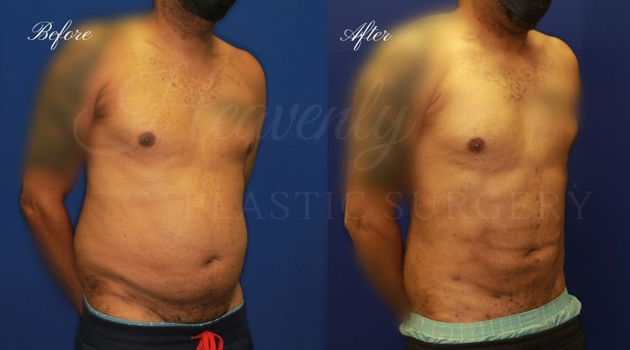 Liposuction 360, liposuction, lipo 360, liposuction surgeon, liposuction orange county, lipo 360 orange county, lipoetching orange county, back liposuction, stomach liposuction, liposuction before and after, lipoetching before and after, liposuction 360 before and after, liposuction results, lipoetching results