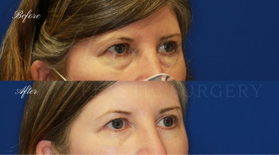 Plastic surgeon, plastic surgery, lower blepharoplasty, eyelid surgery, treating eyelid bags and dark circles under eyes