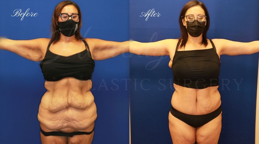 Plastic Surgery, plastic surgeon, mommy makeover, arm lift, abdominoplasty, brachioplasty, extra skin Plastic Surgery, plastic surgeon, mommy makeover, arm lift, abdominoplasty, brachioplasty, extra skin