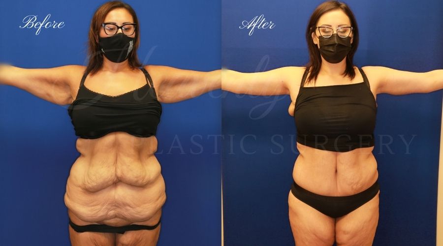 Plastic Surgery, plastic surgeon, mommy makeover, arm lift, abdominoplasty, brachioplasty, extra skin