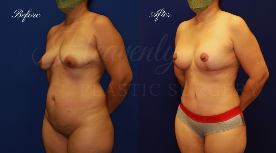 Mommy makeover before and after, mommy makeover surgery, breast lift surgery, tummy tuck surgery, breast lift before and after, tummy tuck before and after, mommy makeover surgeon, mommy makeover surgery, mommy makeover orange county, tummy tuck orange county, breast lift orange county, plastic surgery, plastic surgeon, plastic surgery before and after, mommy makeover journey, mommy makeover results, tummy tuck journey, tummy tuck results, plastic surgery results, orange county plastic surgeon, orange county plastic surgery, plastic surgery orange county Mommy makeover before and after, mommy makeover surgery, breast lift surgery, tummy tuck surgery, breast lift before and after, tummy tuck before and after, mommy makeover surgeon, mommy makeover surgery, mommy makeover orange county, tummy tuck orange county, breast lift orange county, plastic surgery, plastic surgeon, plastic surgery before and after, mommy makeover journey, mommy makeover results, tummy tuck journey, tummy tuck results, plastic surgery results, orange county plastic surgeon, orange county plastic surgery, plastic surgery orange county