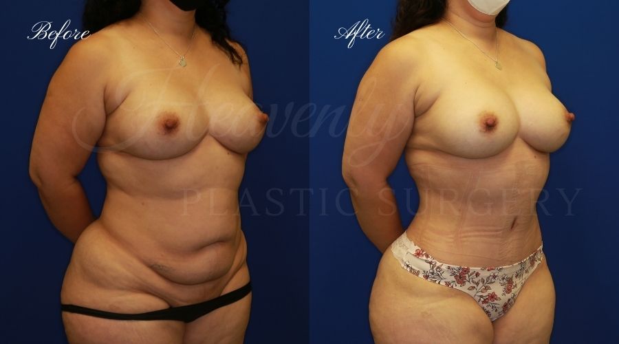 Before & After Abdominoplasty & Breast Augmentation utiliz…